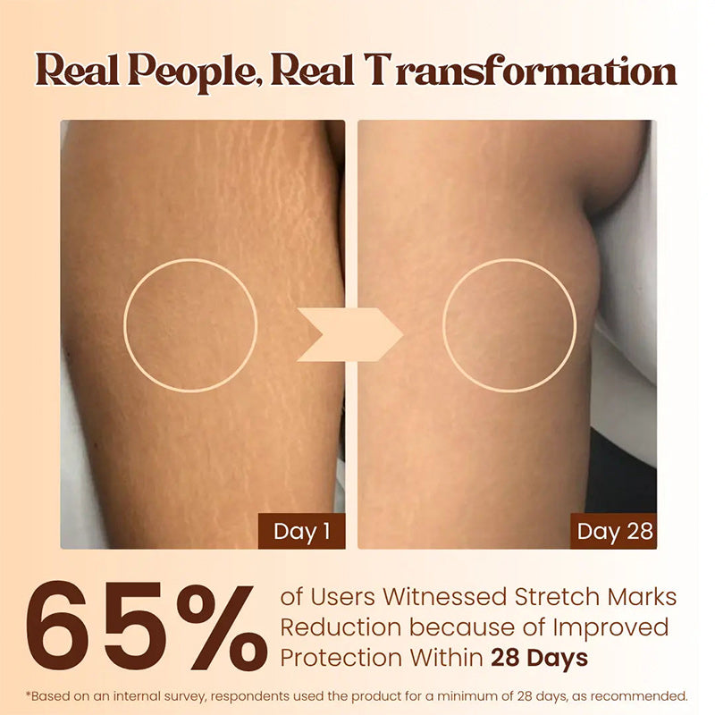 💖Mother’s Day Special: Virexo Stretch Mark Cream –––Give Mom the Skin She Deserves 💖