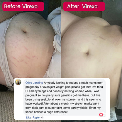 💖Virexo Stretch Mark System🌸 Safe for postpartum & breastfeeding moms
