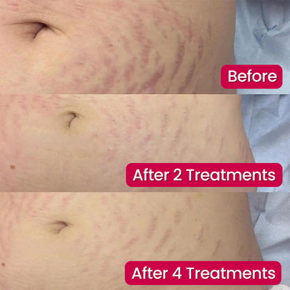 💖Virexo Stretch Mark System🌸 Safe for postpartum & breastfeeding moms