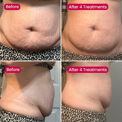 💖Virexo Stretch Mark System🌸 Safe for postpartum & breastfeeding moms