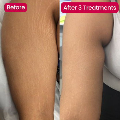 💖Virexo Stretch Mark System🌸 Safe for postpartum & breastfeeding moms