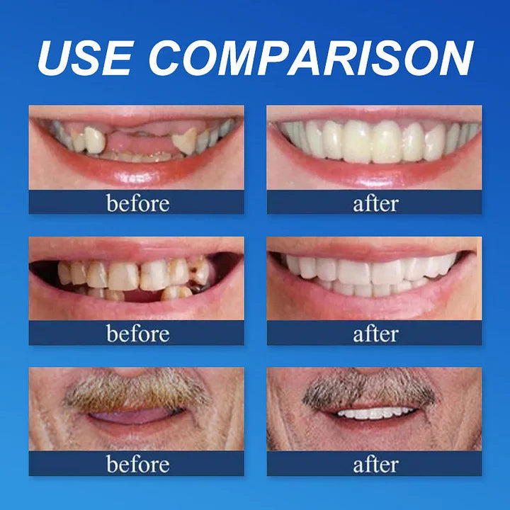 Ends Today: 70% OFF! ⏰70% OFF! EETTSY™ Medical Full Denture with Strong Suctiond Custom-Fit Full Functional Dentures🦷Obtain American Dental Association (ADA) Certification